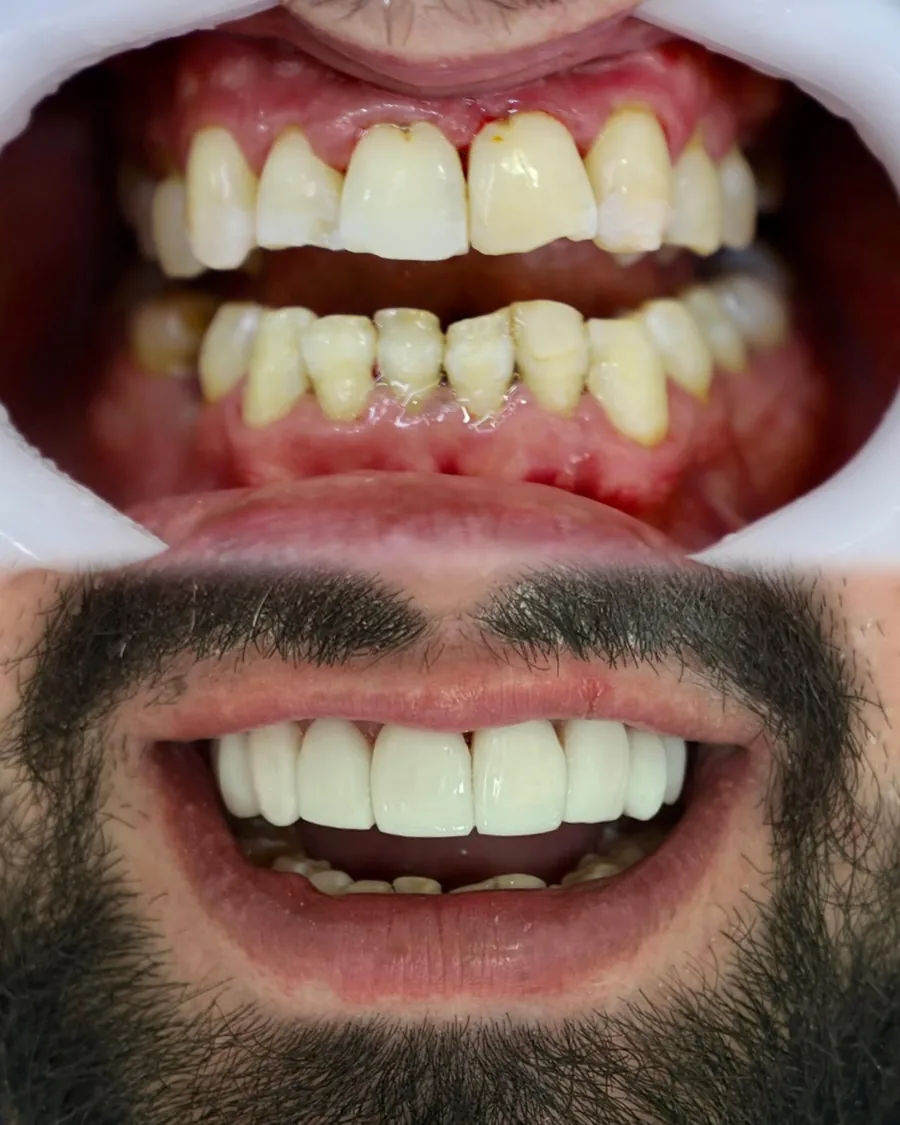Lentes em resina: sorriso antes (em cima) e depois